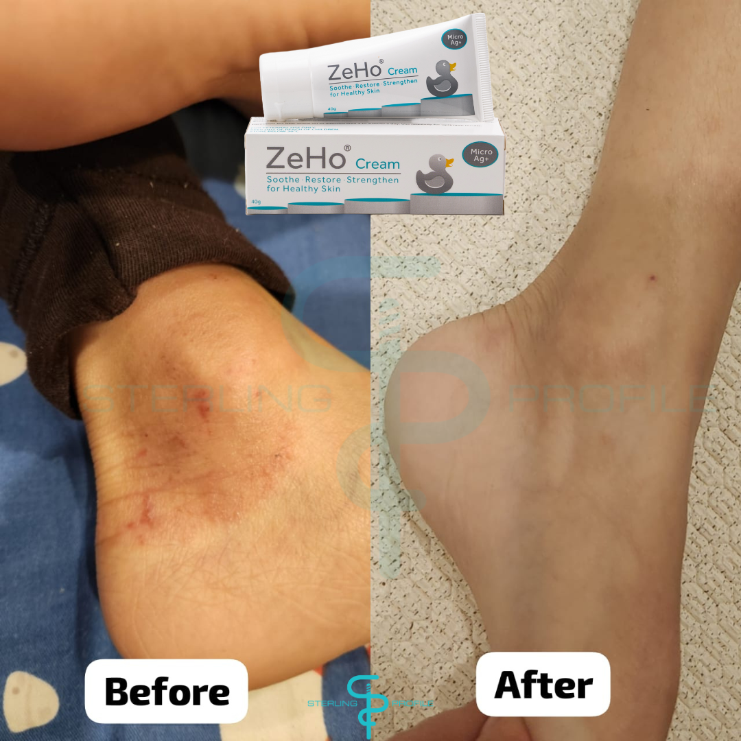 ZeHo MicroAg+ Cream Testimonial  & Sterling Profile Sdn Bhd