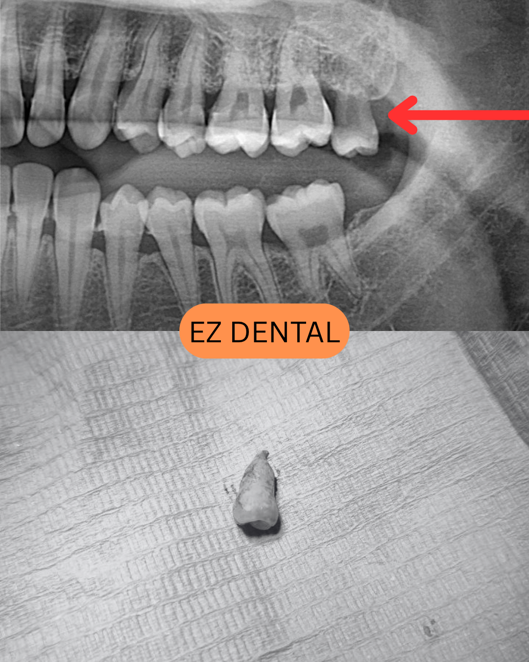 Wisdom Tooth Surgery