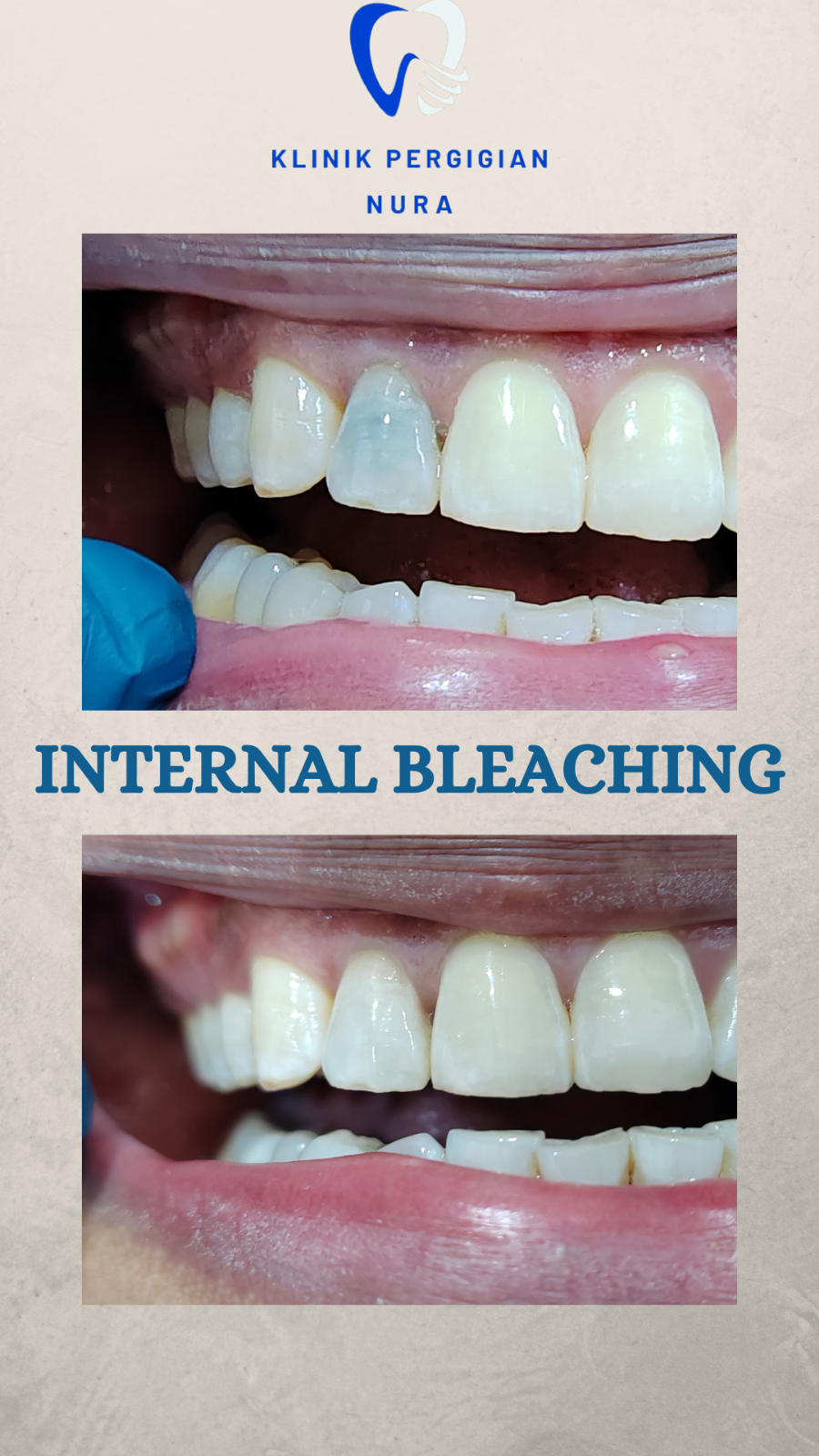 INTERNAL BLEACHING