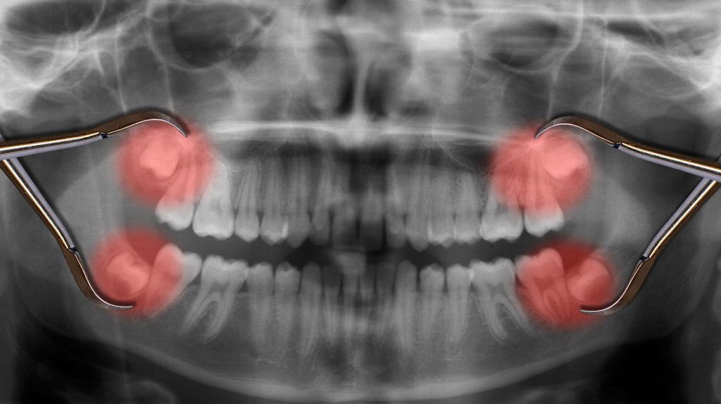 Painless Wisdom Tooth Removal Johor Bahru | Safe Wisdom Tooth Extraction JB Mount Austin & Taman Pelangi