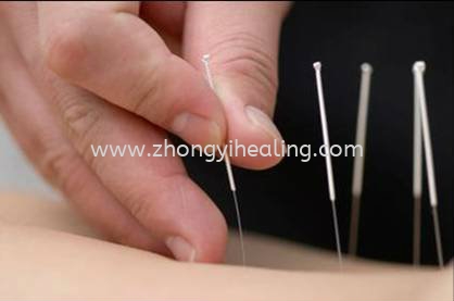 ݶ β Acupuncture Treatment  Kuala Lumpur, KL, Cheras, Selangor, Malaysia. Traditional Chinese Medicine, Acupuncture, Joint Pain, Arthritis, Arthralgia, Slimming, Period Pain | Yik Shou Enterprise