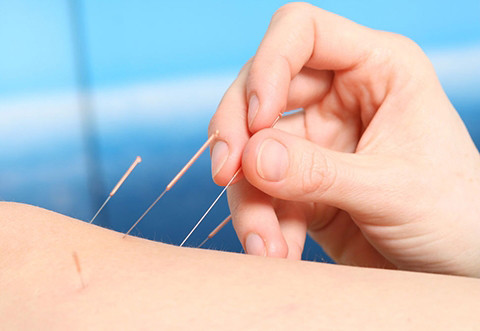 Acupuncture Health Care 针灸保健