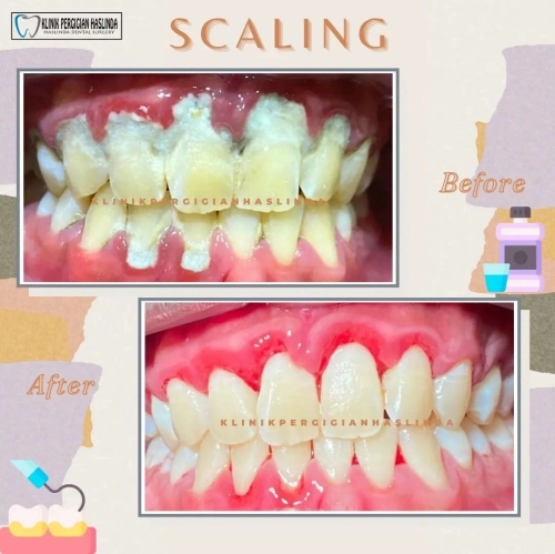 Scaling Treatment