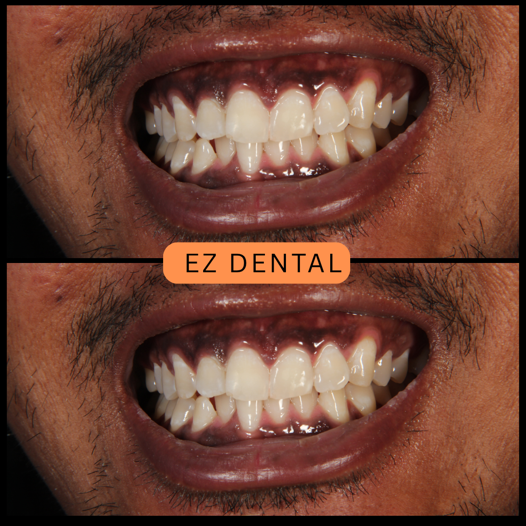 Teeth Whitening