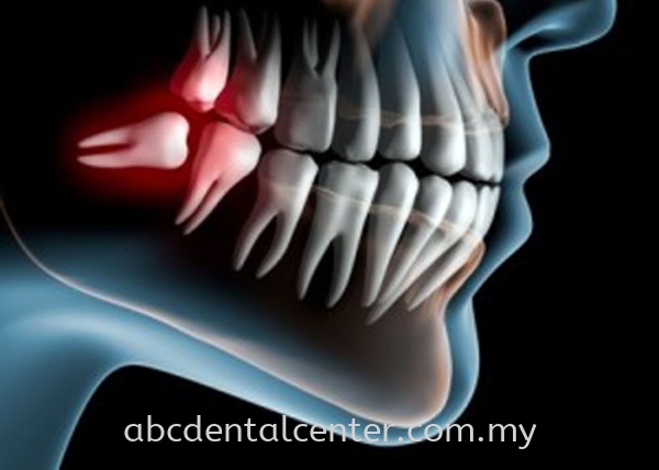 Wisdom Tooth Removal ǻ Wisdom Tooth Removal Johor Bahru (JB), Adda Heights, Malaysia Services | ABC Dental Sdn Bhd