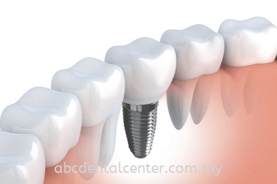 Dental Implants ֲ