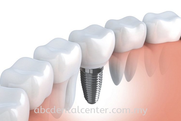 Dental Implants ֲ Dental Implants Johor Bahru (JB), Adda Heights, Malaysia Services | ABC Dental Sdn Bhd