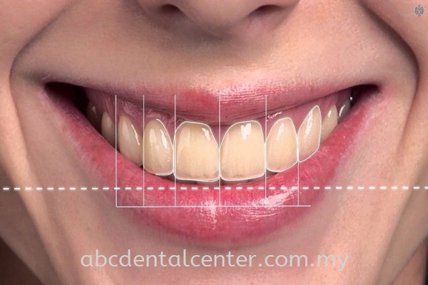 Digital Smile Design Digital Smile Design Johor Bahru (JB), Adda Heights, Malaysia Services | ABC Dental Sdn Bhd