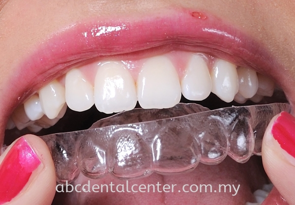 abc Aligner  abc Aligner Johor Bahru (JB), Adda Heights, Malaysia Services | ABC Dental Sdn Bhd