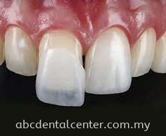 Veneer Ƭ Crown and Bridge  Johor Bahru (JB), Adda Heights, Malaysia Services | ABC Dental Sdn Bhd