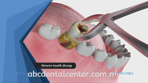  Extraction  Extraction  Johor Bahru (JB), Adda Heights, Malaysia Services | ABC Dental Sdn Bhd