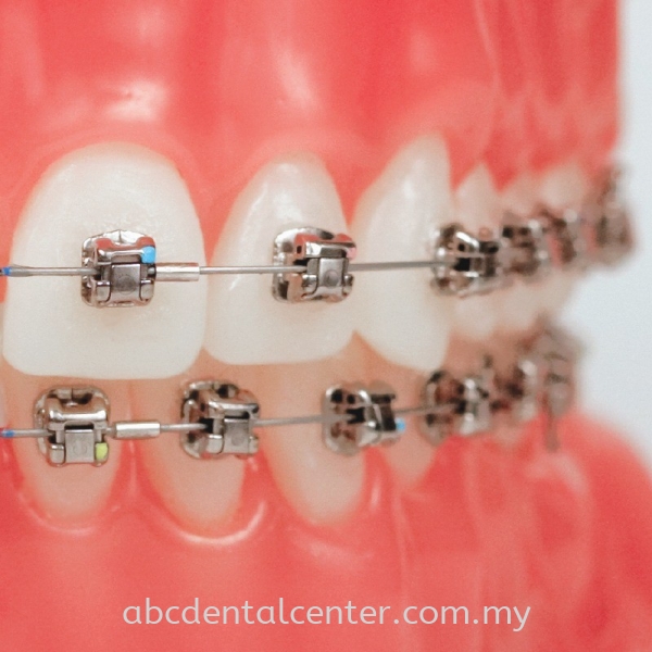 Damon braces  Braces Johor Bahru (JB), Adda Heights, Malaysia Services | ABC Dental Sdn Bhd