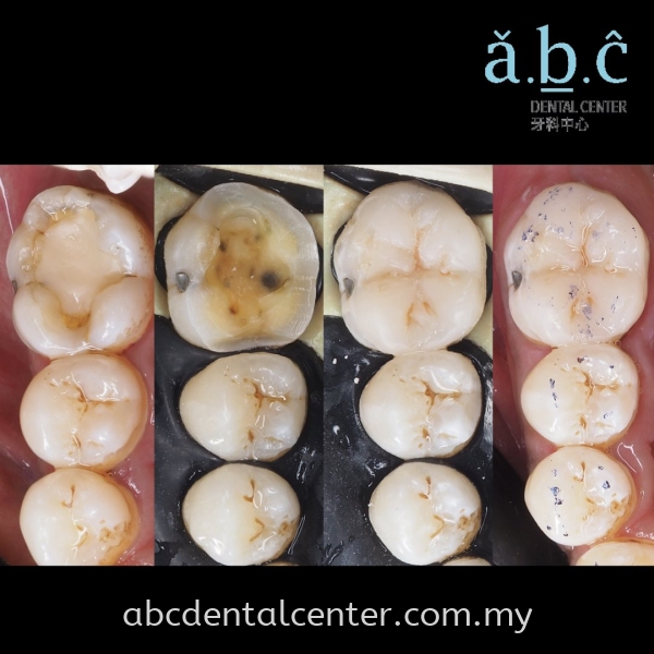 Fillings  Fillings Johor Bahru (JB), Adda Heights, Malaysia Services | ABC Dental Sdn Bhd