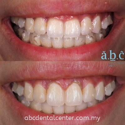 Gingival recontouring