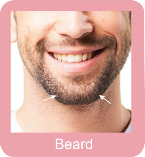 Permanent hair removal Beard