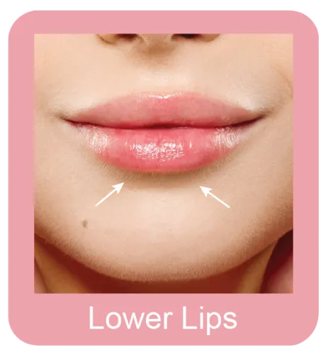 Permanent hair removal lower lips