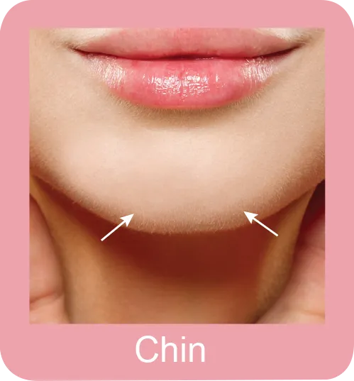 Hair Removal Chin