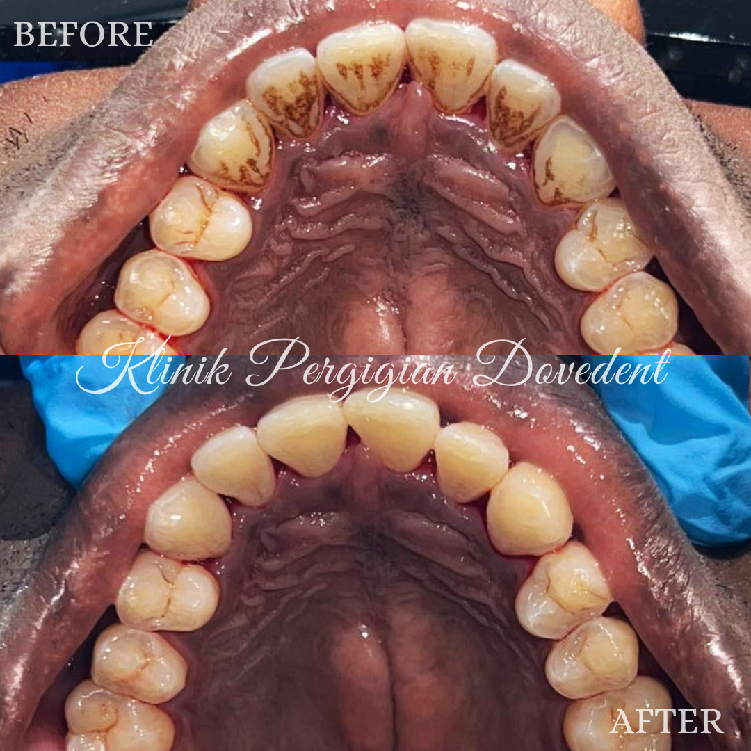 Teeth Scaling & Polishing