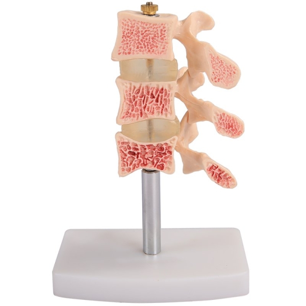 V.29 CUTAWAY OSTEOPOROSIS ģ V. Models ģ Selangor, Malaysia, Kuala Lumpur (KL), Petaling Jaya (PJ) Supplier, Suppliers, Supply, Supplies | San-Tronic Medical Devices Sdn Bhd