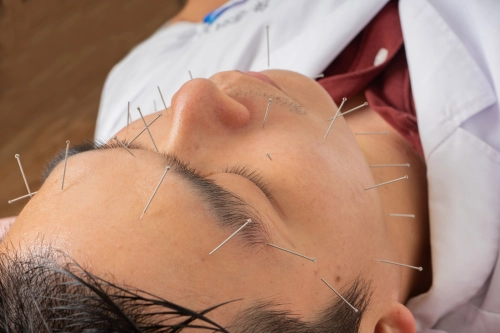 FACIAL REJUVENATION ACUPUNCTURE(Buy 5 free 1)