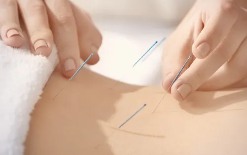  ACUPUNCTURE FOR WEIGHT LOSS(Buy 5 free 1)