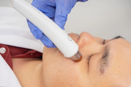 FACIAL REJUVENATION ACUPUNCTURE+FACIAL GUA SHA(Buy 5 free 1)