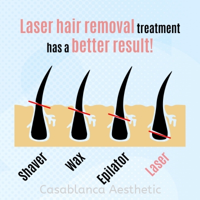 Diode Laser Hair Removal