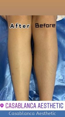 Diode Laser Hair Removal