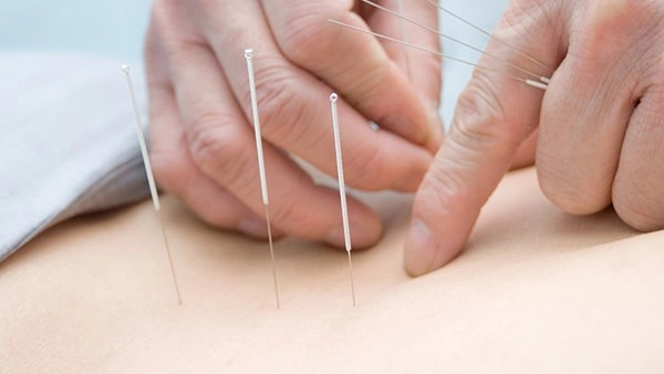 Acupuncture