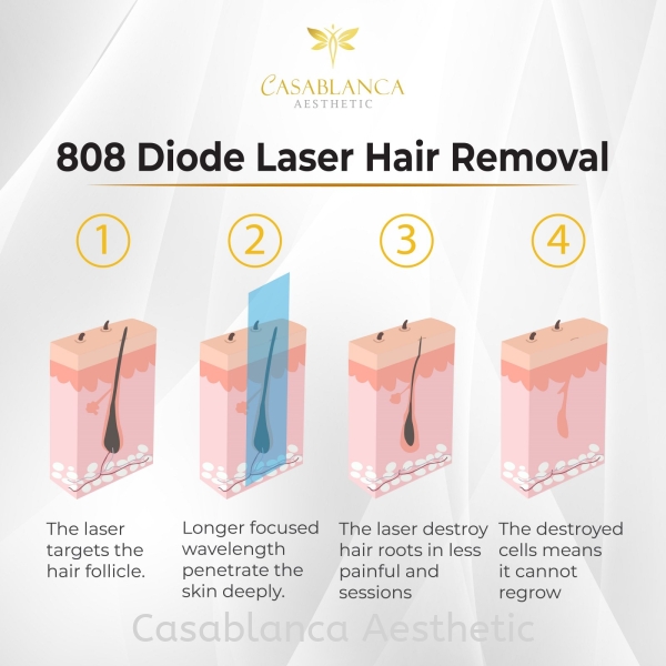 808 Diode Laser Hair Removal Diode Laser Hair Removal  Kuala Lumpur (KL), Malaysia, Selangor, Ampang, Petaling Jaya (PJ) Services | CASABLANCA AESTHETIC