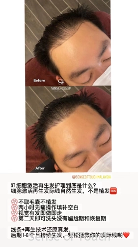 Sense Of Touch Hair Loss Treatment Testimony / 面对脱发问题 & 生发护理