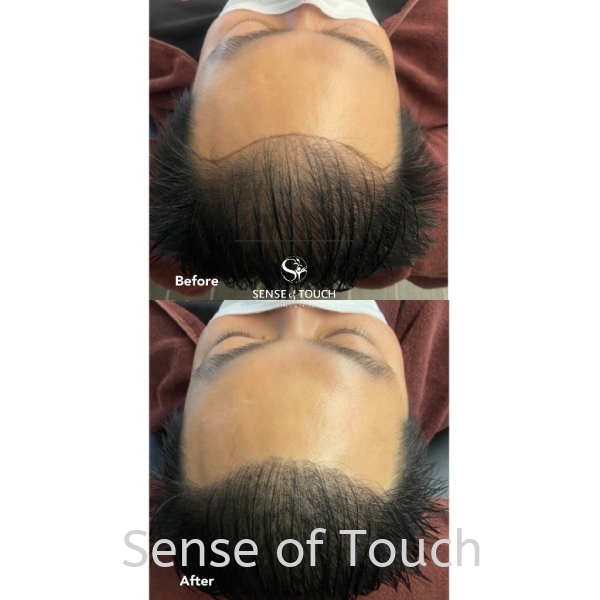 Sense Of Touch Hair Loss Treatment Testimony / 面对脱发问题 & 生发护理 Hair Loss Treatment / 脱发问题· Scalp Treatment / 头皮护理 Selangor, Subang, Malaysia, Kuala Lumpur (KL), Petaling Jaya (PJ) Hair, Service, Salon, Specialist | Sense of Touch Sdn Bhd