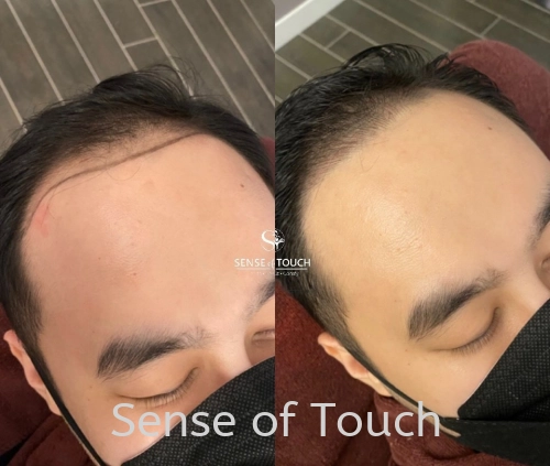 Sense Of Touch Hair Loss Treatment Testimony / 面对脱发问题 & 生发护理