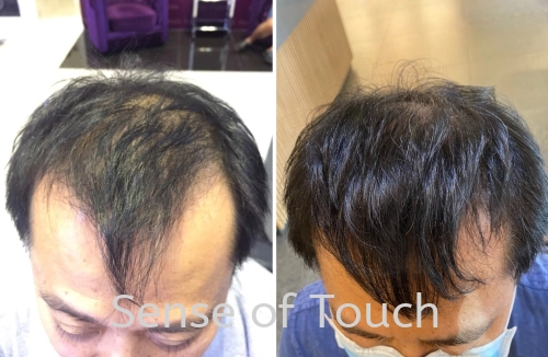 Sense Of Touch Hair Loss Treatment Testimony / 面对脱发问题 & 生发护理