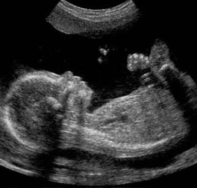 Detailed Scan Ultrasound (Second Trimester)