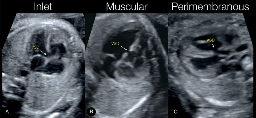 Follow-up Targeted Detailed Scan Ultrasound