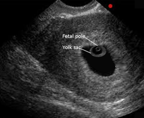 Confirmation Pregnancy Ultrasound Scan (include consultation)