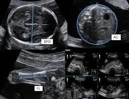 Ultrasound Pertumbuhan Trimester Ketiga