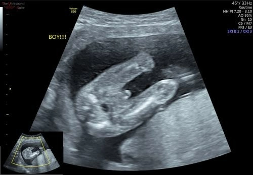 Fetal Gender Ultrasound Scan