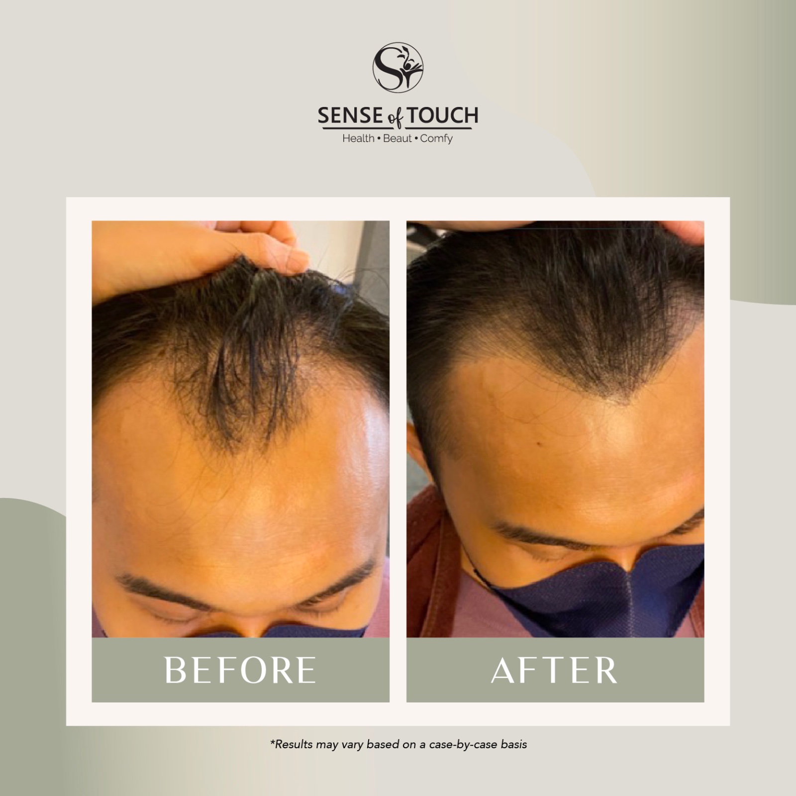 Sense Of Touch Hair Loss Treatment Testimony / 面对脱发问题 & 生发护理