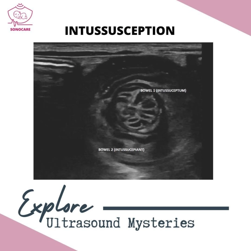 What is Intussusception?