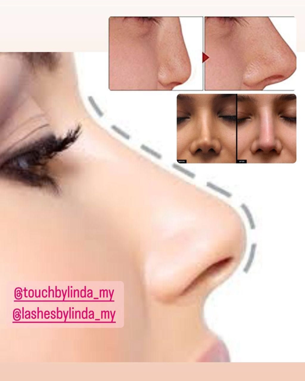 Nose Filler H.A High Bone