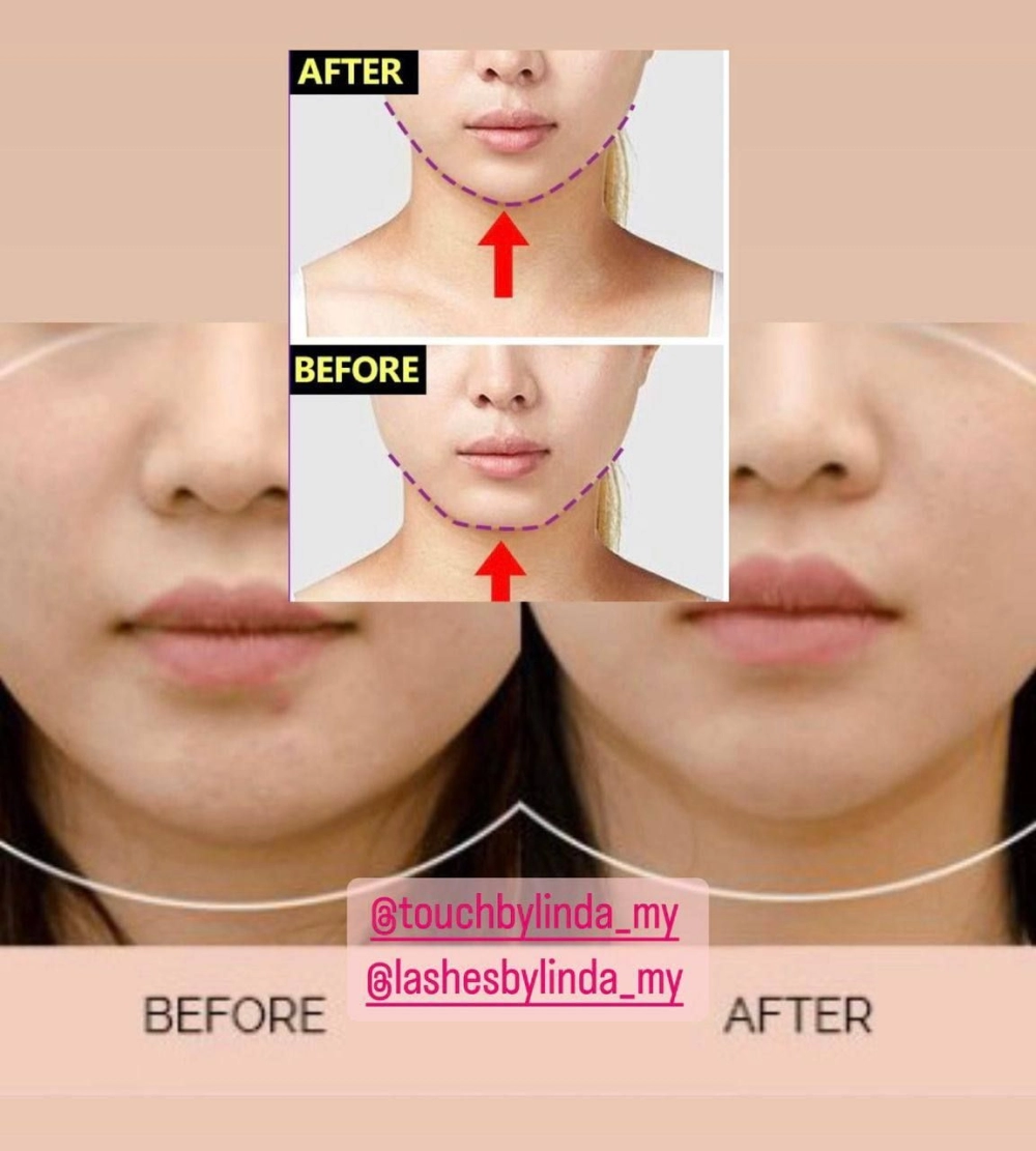 Chin Filler Vshape