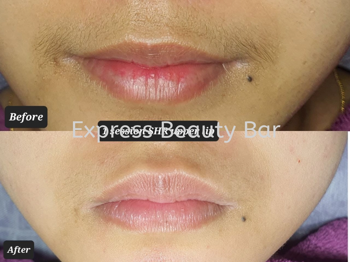 SHR Upper Lip Treatment @Bangsar Customer