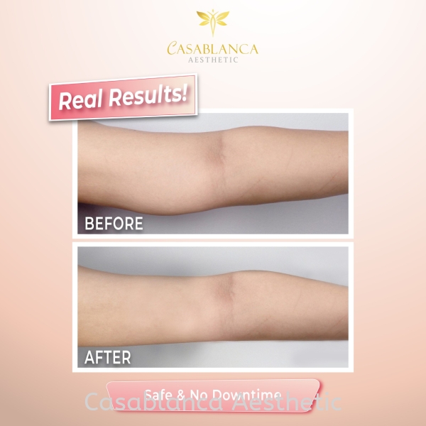 Barbie Line Arm Fat Melt  Meso Slimming   Services | CASABLANCA AESTHETIC