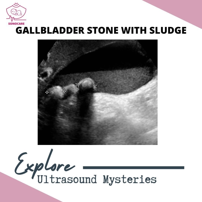Gallbladder stone with sludge