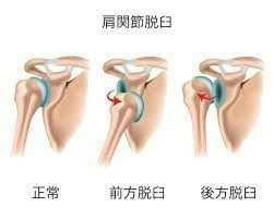 肩膀脱臼治疗