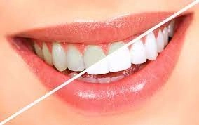 Tooth Whitening