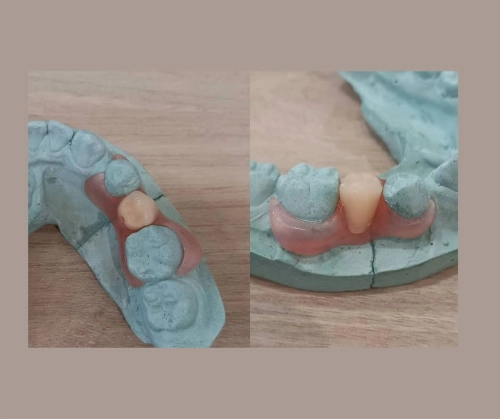 Flexible Denture 软性假牙