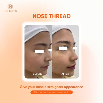 Nose Thread